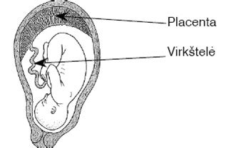 Schematinis vaizdas, kaip atrodo gimda su užsilikusiais audiniais po aborto