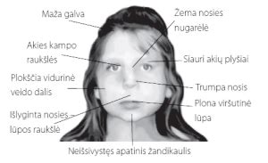 vaizdinis pavyzdys veido bruožų sergant VAS