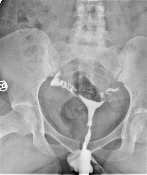 Histerosalpingografijos (HSG) atlikimo principas