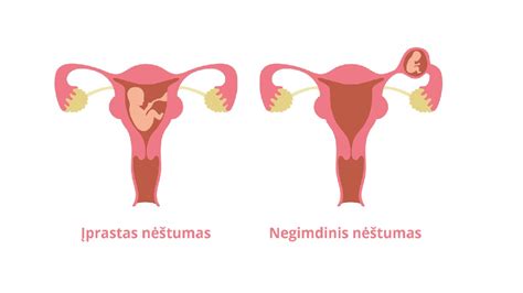 simptomų palyginimas: normalus nėštumas vs negimdinis nėštumas