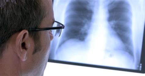 Krūtinės ląstos rentgenograma su tuberkuliozės židiniais