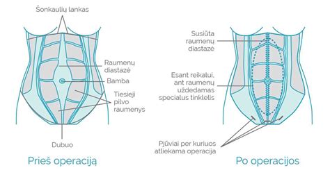 Pilvo raumenų diastazės vaizdas ir chirurginio gydymo etapai