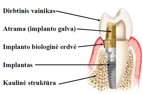 Danties implanto įsodinimo schema