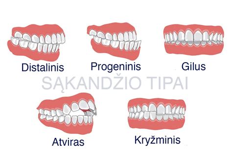 Dantų traumų tipai infografikas