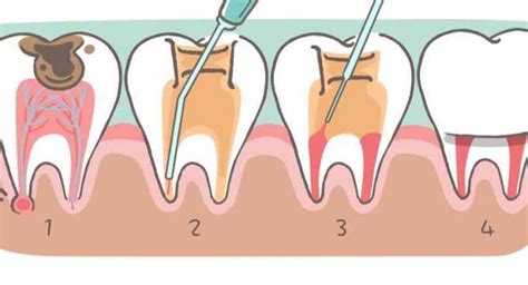 Pieninio danties įmušimo schema