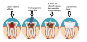 Danties šaknies lūžio vizualizacija