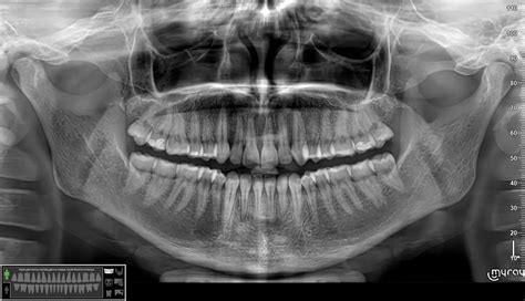 Dantų rentgeno nuotrauka po traumos