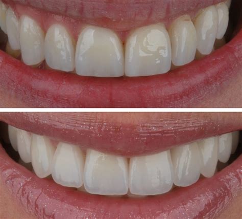 Dantų traumos gydymo prieš ir po pavyzdys