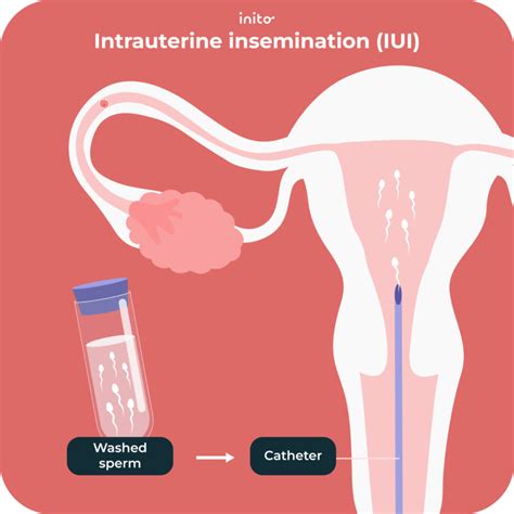 schema, vaizduojanti intrauterininės inseminacijos (IUI) eigą: spermatozoidų įvedimas į gimdą
