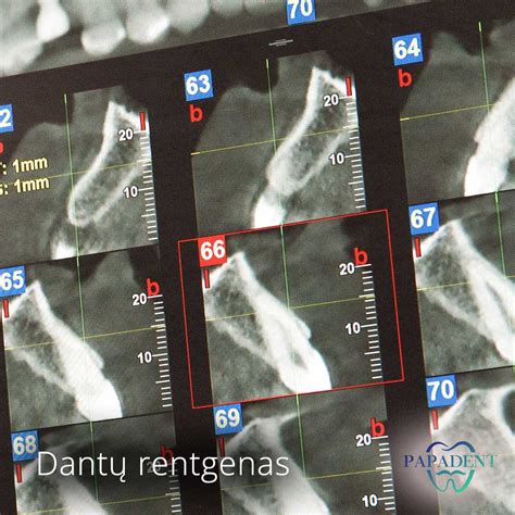 Rentgenas, rodantis danties šaknies pūlinį