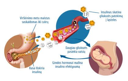 schema, paaiškinanti insulino veikimą nėštumo metu ir gliukozės perteklių kraujyje