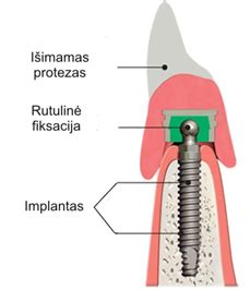 TESA procedūros schematinis vaizdas