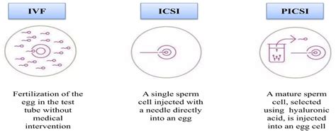 ICSI ir PICSI procedūrų palyginimas