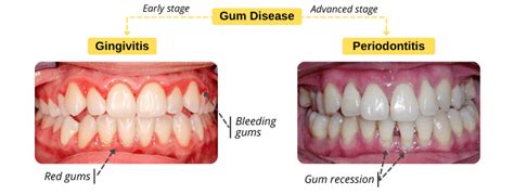 Gingivito ir periodontito palyginimas