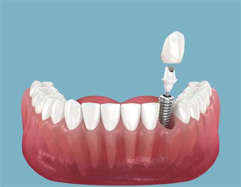 Dantų implantas ir protezai