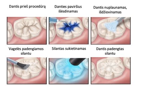 dantų silantai