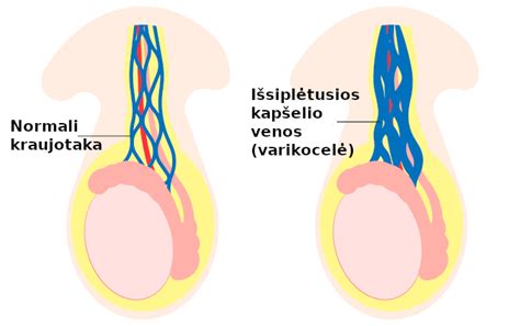 schema, vaizduojanti varikocelės poveikį sėklidėms
