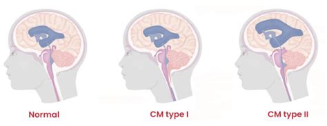 Chiari apsigimimo tipų schema