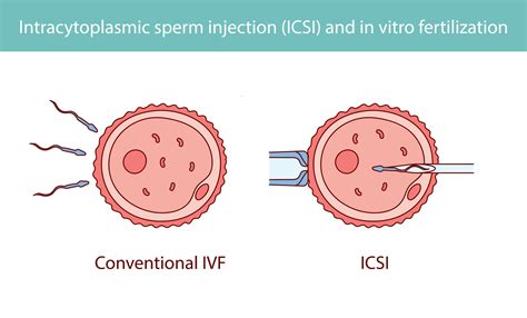 Schema, iliustruojanti intrauterininės inseminacijos (IUI) ir apvaisinimo mėgintuvėlyje (IVF) procesus