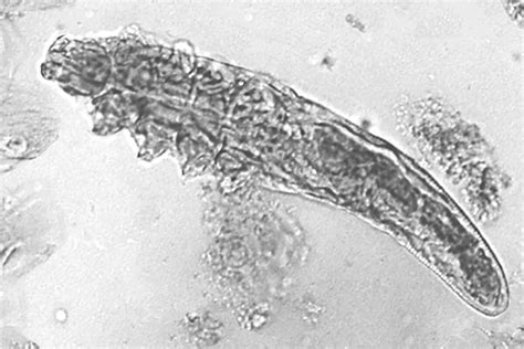 Demodex erkutė mikroskopo vaizde