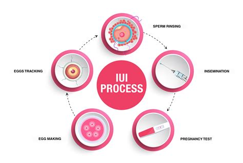 schema, vaizduojanti intrauterininės inseminacijos (IUI) procesą