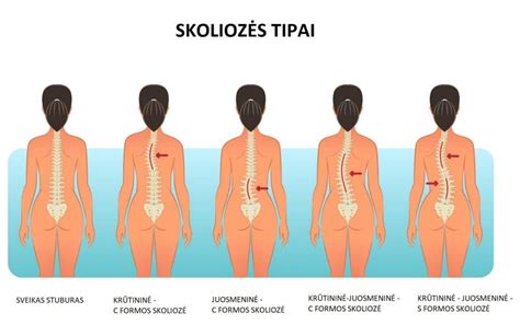 skoliozės scheminis vaizdas