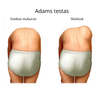 atliekamas Adams testas