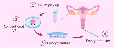 IVF embriono perkėlimo schema