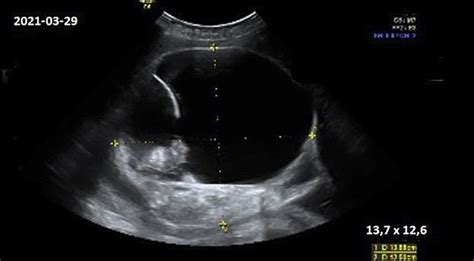 simptomai po cezario pjūvio
