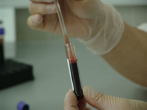 Flebotomijos procedūra