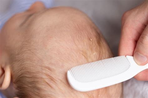 Kūdikio galva su pleiskanų luobele