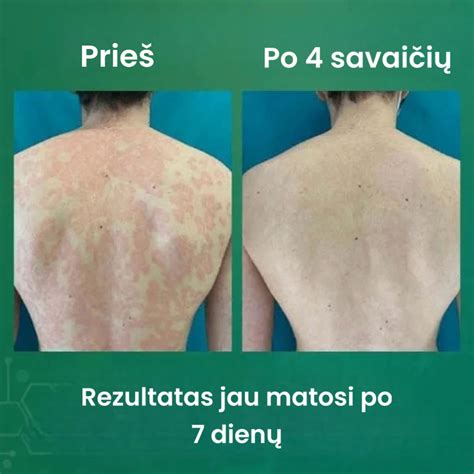 Žvynelinės dedervinės (psoriazės) pavyzdys