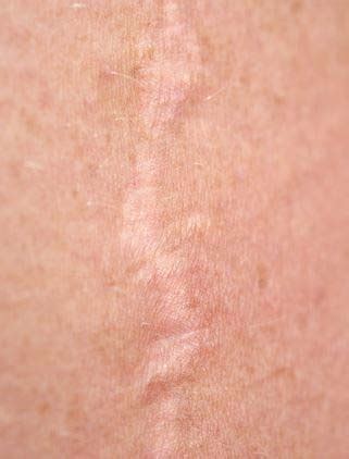 Schema, vaizduojanti skirtingus odos sluoksnius ir kaip formuojasi randas