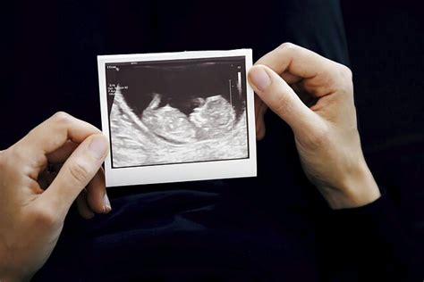 Vaisiaus nuotrauka iš ultragarsinio tyrimo