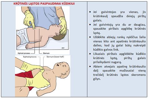 Vaikų krūtinės ląstos chirurgija (schematinis vaizdas)