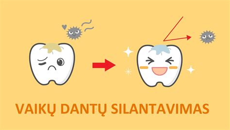 Dantų silantavimas: apsauga nuo ėduonies