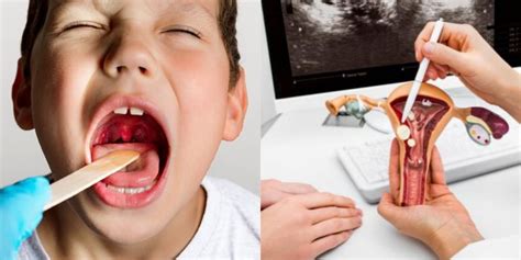 Schematinis adenoidų išvešėjimo stadijų pavaizdavimas