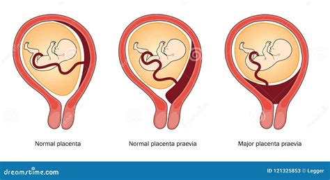 placentos praevia schema