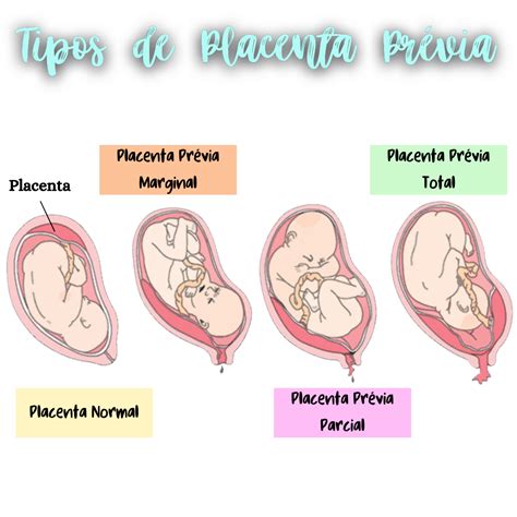 paveikslėlis kaip atrodo placentos atšoka