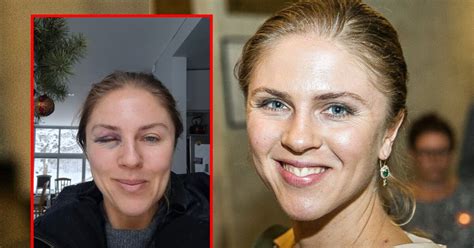 Nuotrauka: kūdikis su traiškanojančia akimi