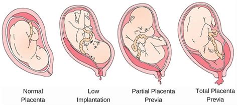 Placentos prisitvirtinimas