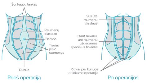 Pilvo sienos anatomija ir bambos žiedas