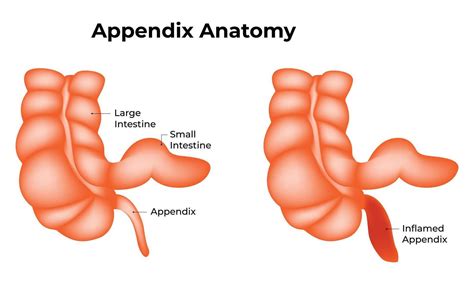 schema of appendix