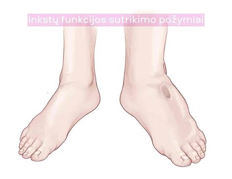 Schematinis kepenų veiklos sutrikimo paveikslas