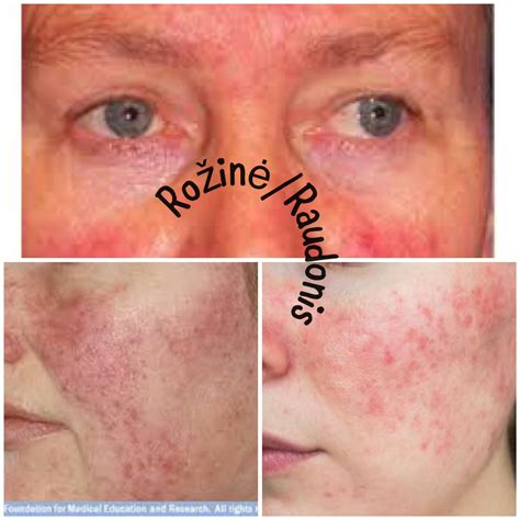 PKS simptomai: moteris su spuogais, veido plaukais ir nuovargiu