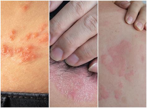 Odos bėrimai prie išangės