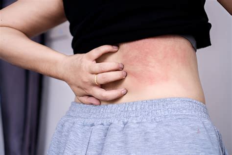 Alerginio kontaktinio dermatito pavyzdys ant odos
