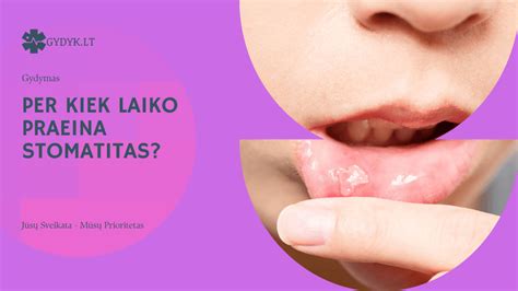 stomatito simptomai burnos gleivinėje