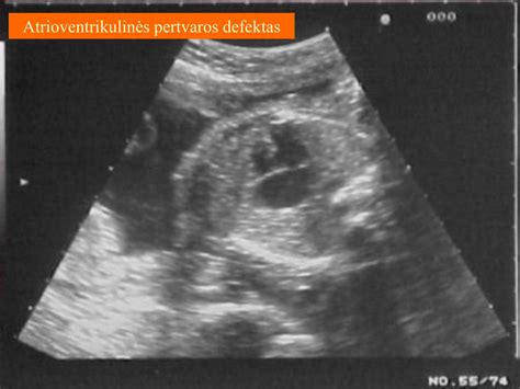 Placentos padėtis ir vaisiaus judesių pajautimas