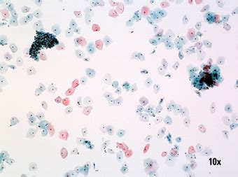 Įprasto tepinėlio (1 pav.) ir THINPREP® PAP (2 pav.) tyrimo skirtumai stebint ląsteles per mikroskopą